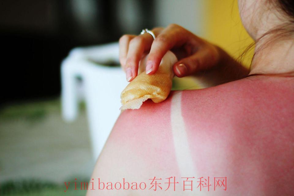 脸晒伤了怎么办才能快速恢复（这些晒伤家庭疗法会很快治愈你的皮肤）