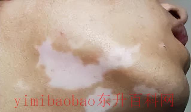 白癜风是什么病（白癜风是怎么引起的？什么方法可以治好白癜风？）