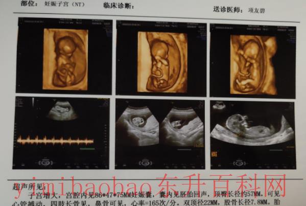nt三个亮点是男孩女孩?男孩(非专业筛查性别检查)